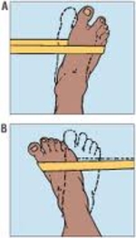 Bunion Surgery - Eagle Rock Physical Therapy