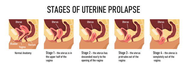 Pelvic Organ Prolapse - Eagle Rock Physical Therapy