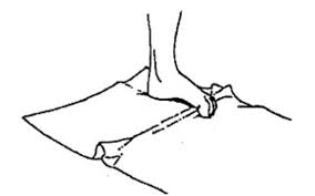 Bunion Surgery - Eagle Rock Physical Therapy